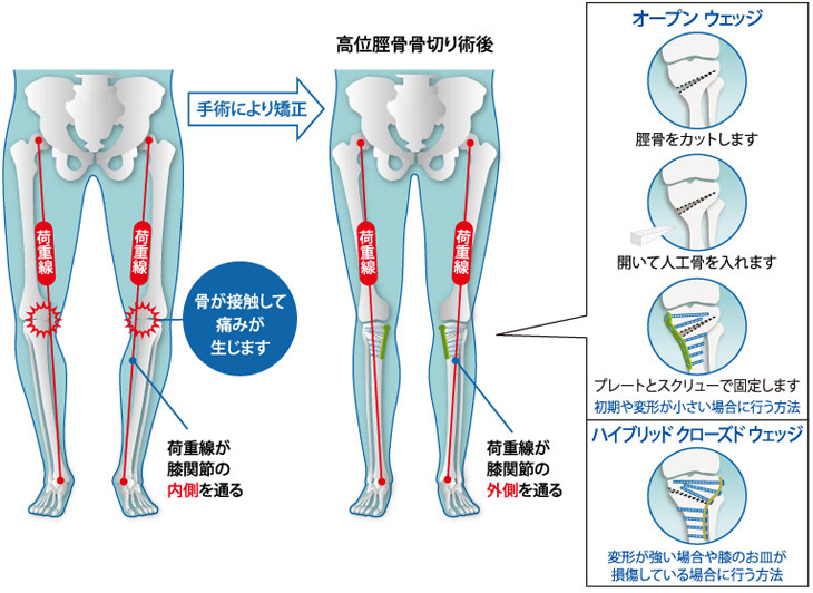 荷重線が膝関節の内側を通ってしまうと、荷重線と骨が接触して痛みが生じてしまいます。手術により矯正することで、荷重線が膝関節の外側を通るようになります。オープンウェッジとは：脛骨をカットして開いて人工骨を入れ、プレートとスクリューで固定します。初期や変形が小さい場合に行う方法です。 ハイブリッドクローズドウェッジとは：変形が強い場合や膝のお皿が損傷している場合に行う方法です。