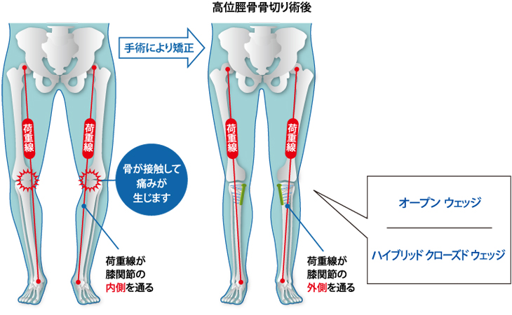荷重線が膝関節の内側を通ってしまうと、荷重線と骨が接触して痛みが生じてしまいます。手術により矯正することで、荷重線が膝関節の外側を通るようになります。